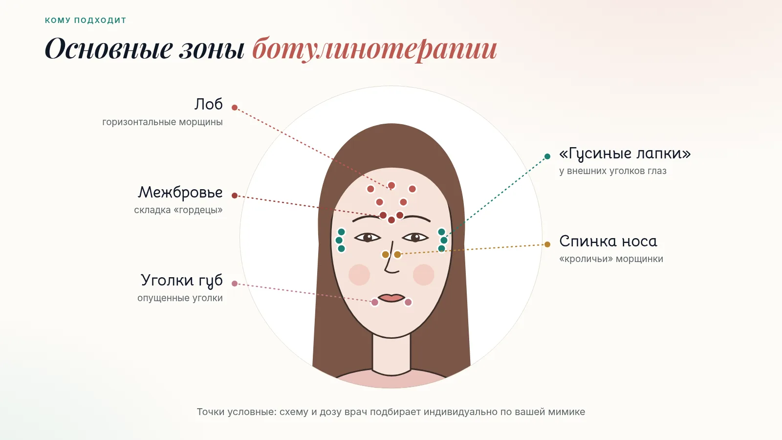 Схема основных зон ботулинотерапии на лице: лоб, межбровье, «гусиные лапки», спинка носа и уголки губ