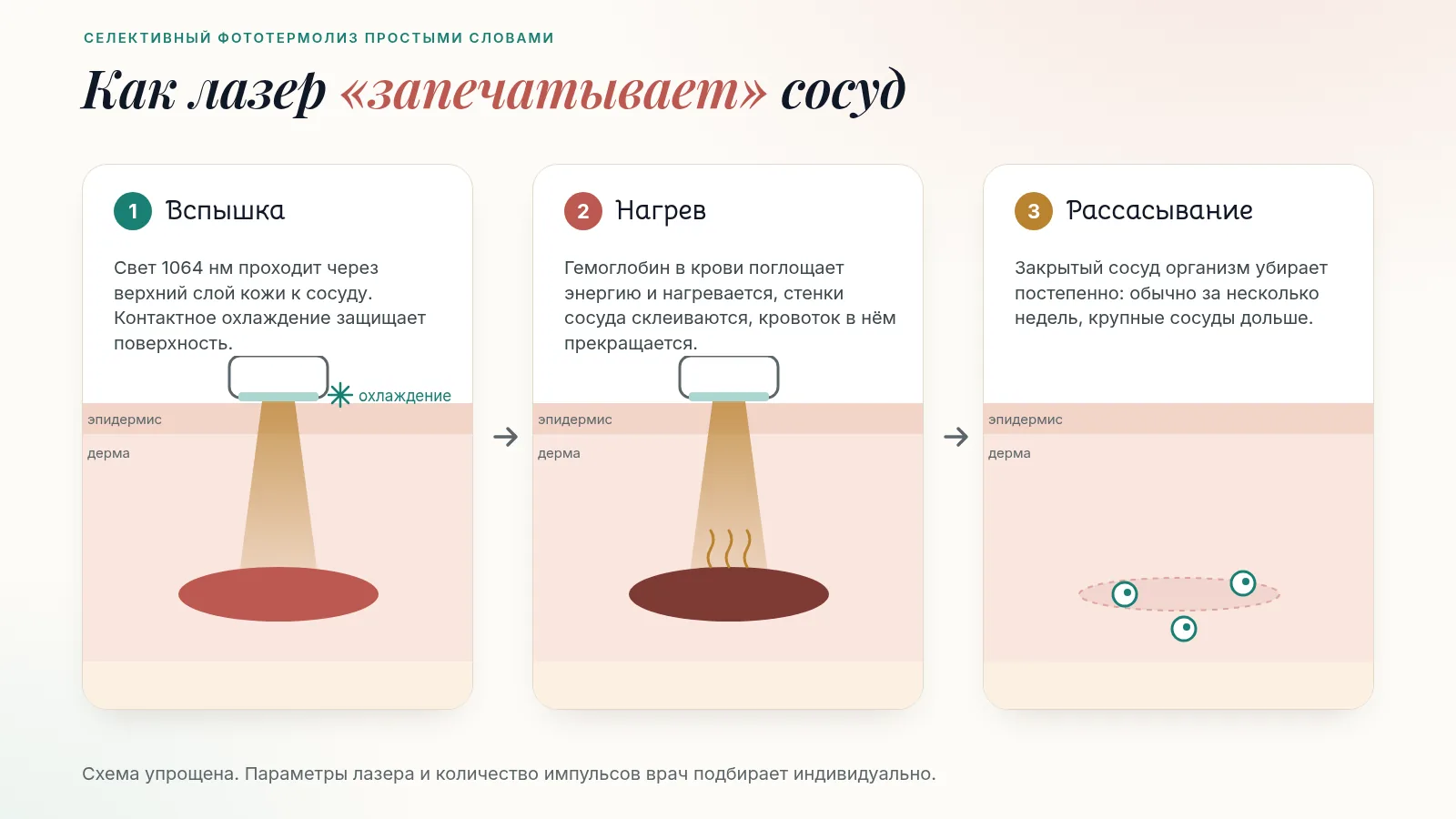 Схема работы неодимового лазера: свет 1064 нм проходит через эпидермис к сосуду, гемоглобин нагревается и сосуд закрывается, затем организм постепенно его рассасывает