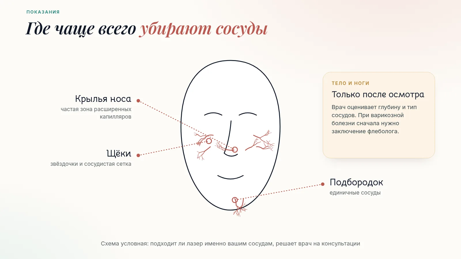 Схема зон удаления сосудов на лице: крылья носа, щёки и подбородок; сосуды на теле и ногах — только после осмотра врача
